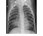 Hybrid MobileNetV2–vision transformer approach for multi-label classification of chest X-rays
